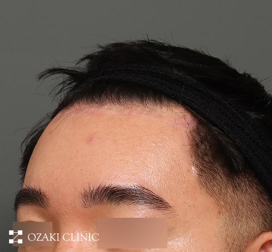 30代男性の額縮小 After 症例写真