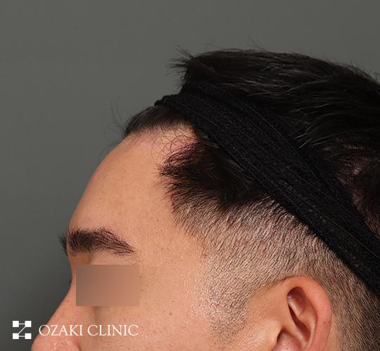 30代男性の額縮小 After 症例写真