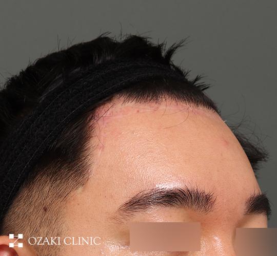 30代男性の生え際前進術 After 症例写真