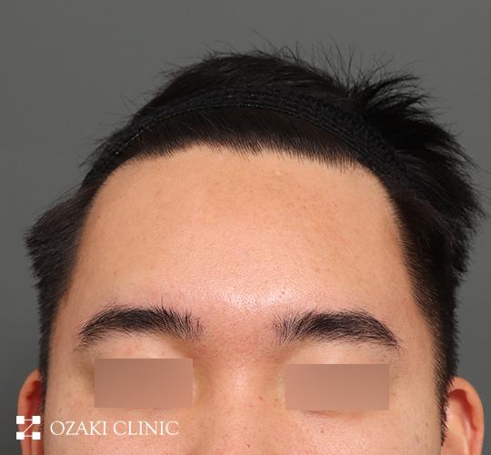 30代男性の額縮小 Before 症例写真