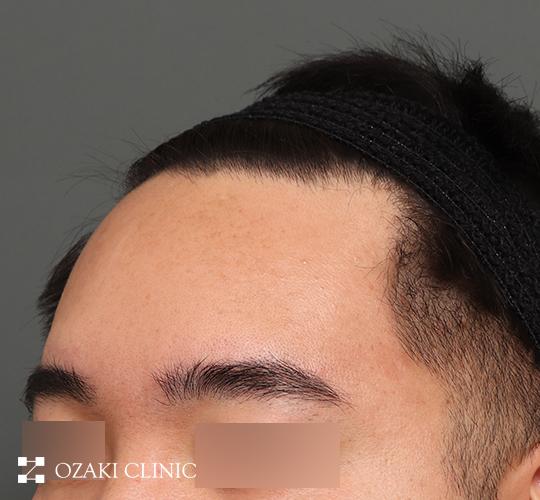 30代男性の額縮小 Before 症例写真