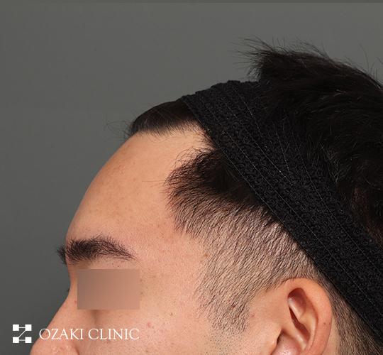30代男性の額縮小 Before 症例写真