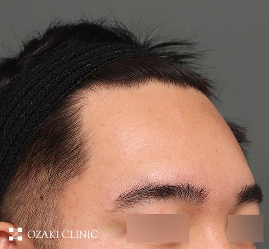 30代男性の生え際前進術 Before 症例写真