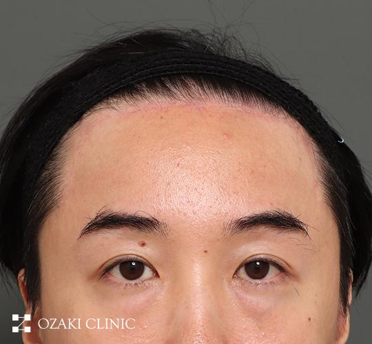 40代男性の額縮小 After 症例写真