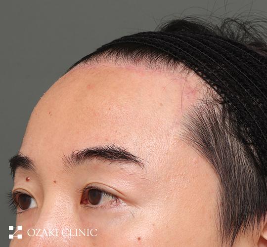40代男性の額縮小 After 症例写真