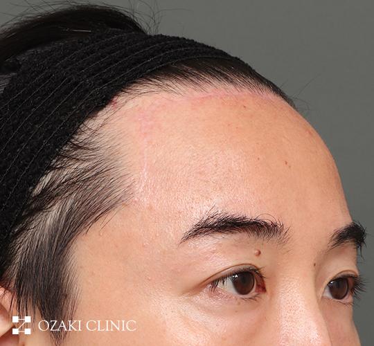 40代男性の生え際前進術 After 症例写真