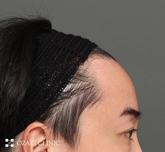 40代男性の額縮小 After 症例写真