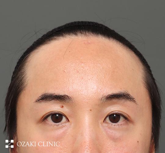 40代男性の額縮小 Before 症例写真