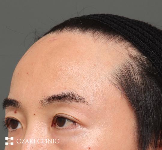 40代男性の額縮小 Before 症例写真