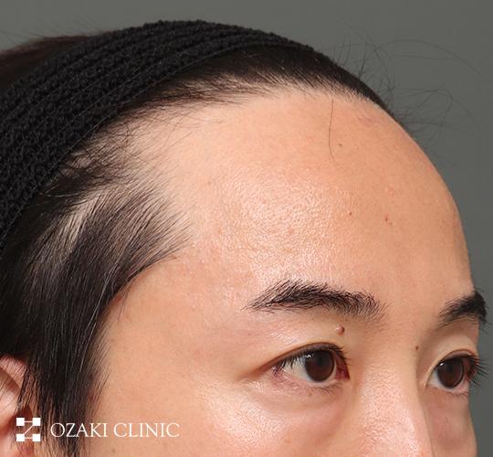 40代男性の生え際前進術 Before 症例写真