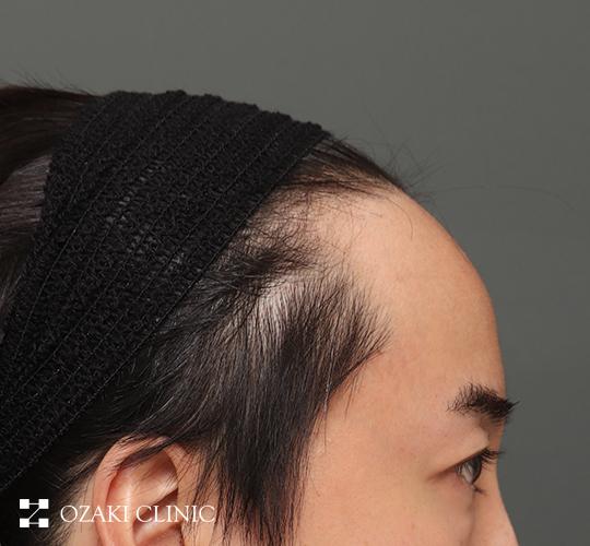 40代男性の額縮小 Before 症例写真