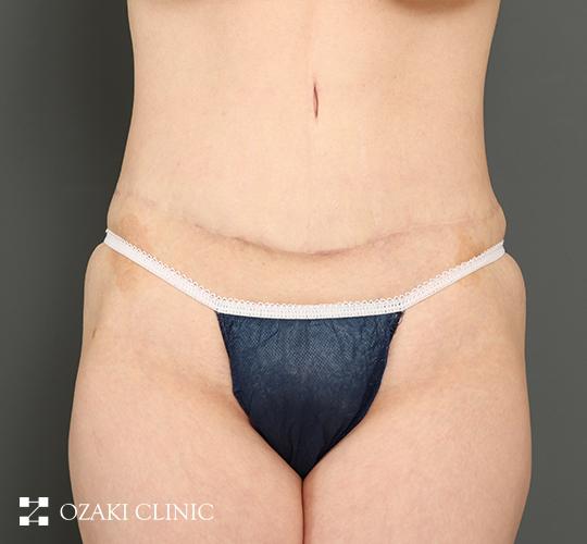 40代女性の外薗式タミータック（腹壁形成術） After 症例写真
