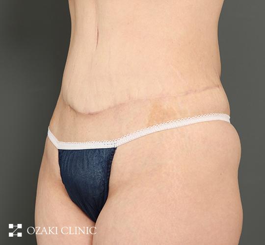 40代女性の外薗式タミータック（腹壁形成術） After 症例写真