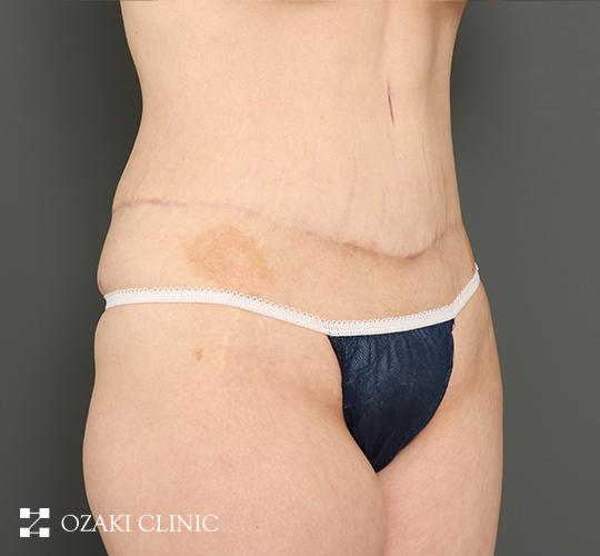 40代女性の外薗式タミータック（腹壁形成術） After 症例写真