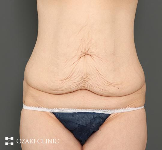 40代女性の外薗式タミータック（腹壁形成術） Before 症例写真