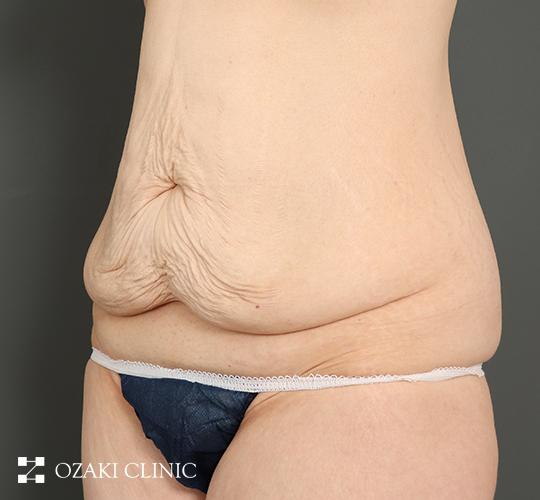 40代女性の外薗式タミータック（腹壁形成術） Before 症例写真