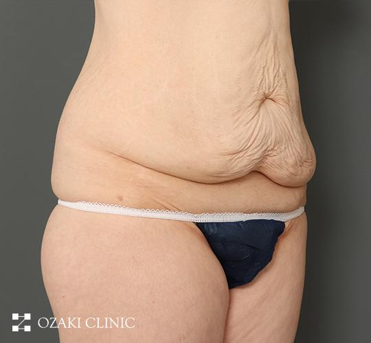 40代女性の外薗式タミータック（腹壁形成術） Before 症例写真