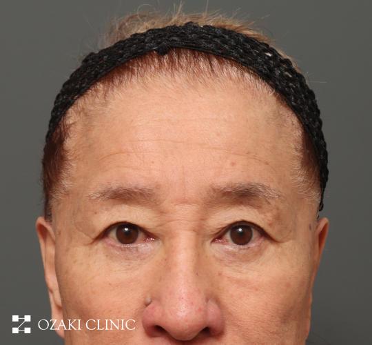 60代男性の生え際前進術 Before 症例写真