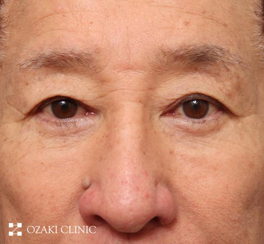 60代男性の生え際前進術 Before 症例写真