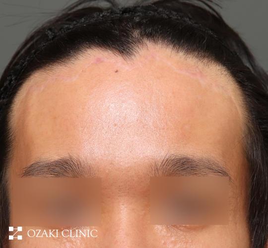 30代男性の生え際前進術 Before 症例写真