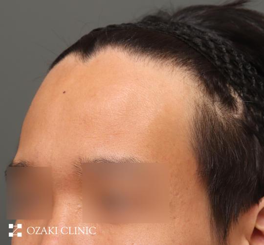30代男性の生え際前進術 Before 症例写真