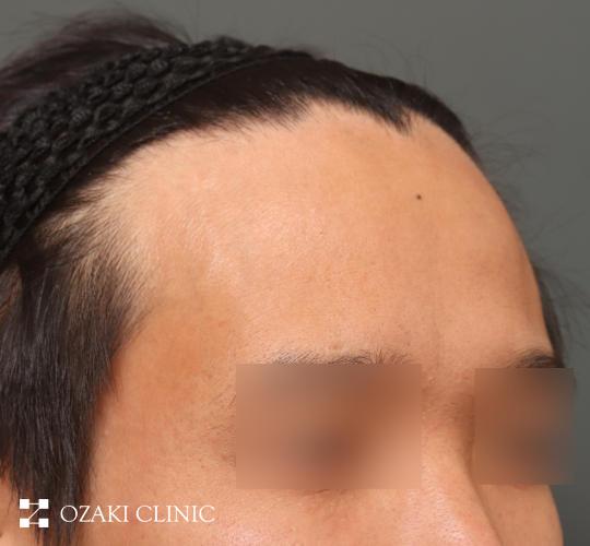 30代男性の生え際前進術 Before 症例写真