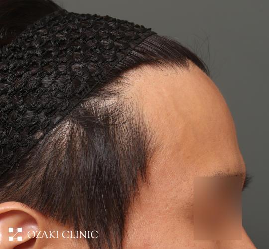 30代男性の生え際前進術 Before 症例写真
