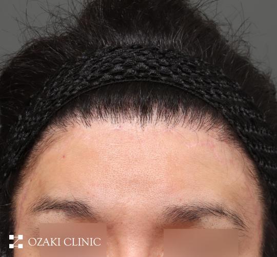 30代男性のまぶた・こめかみリフト After 症例写真