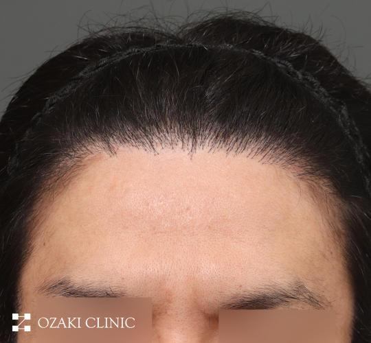 30代男性のまぶた・こめかみリフト Before 症例写真