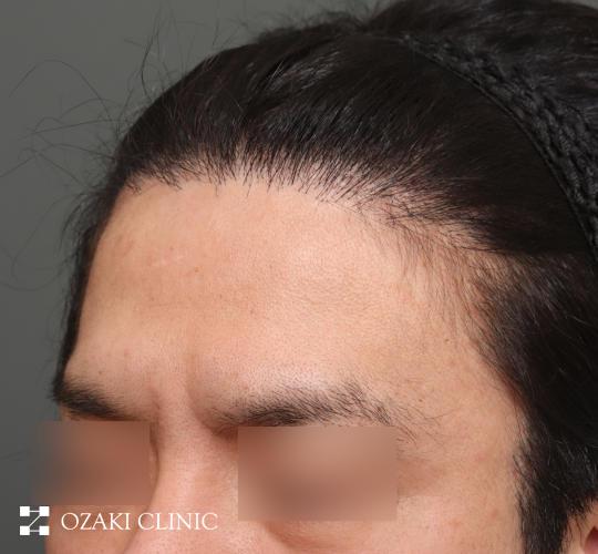 30代男性の生え際前進術 Before 症例写真