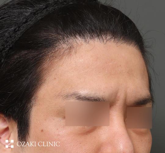30代男性の生え際前進術 Before 症例写真