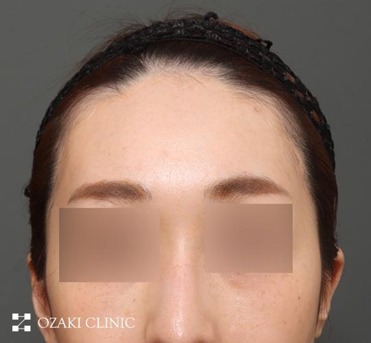 30代女性の額縮小 After 症例写真