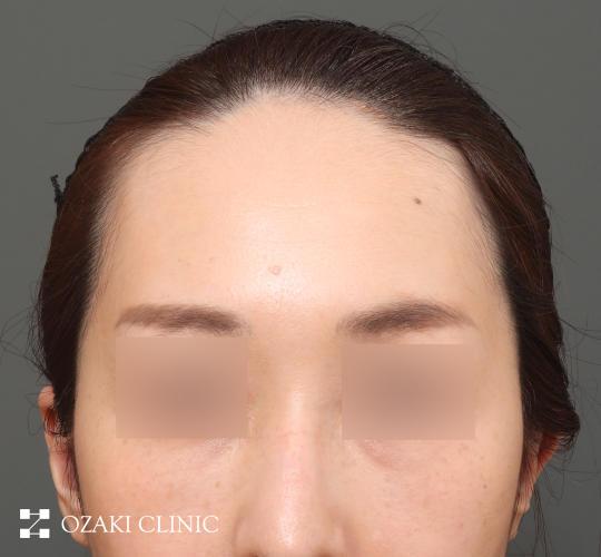 30代女性の額縮小 Before 症例写真