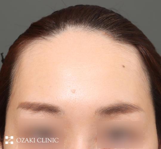 30代女性の額縮小 Before 症例写真