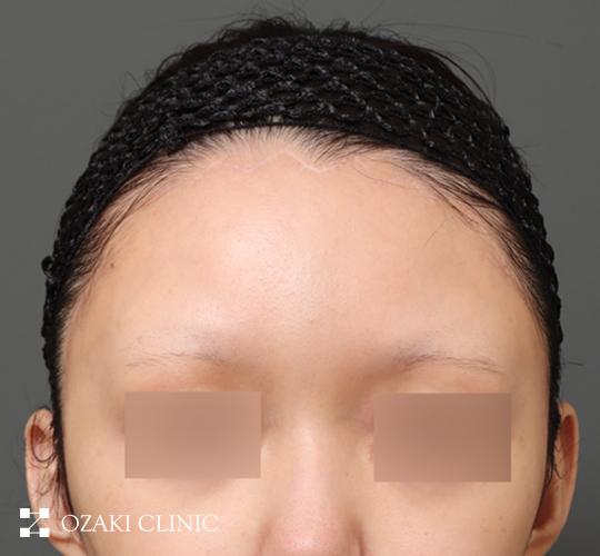 20代女性の額縮小 After 症例写真