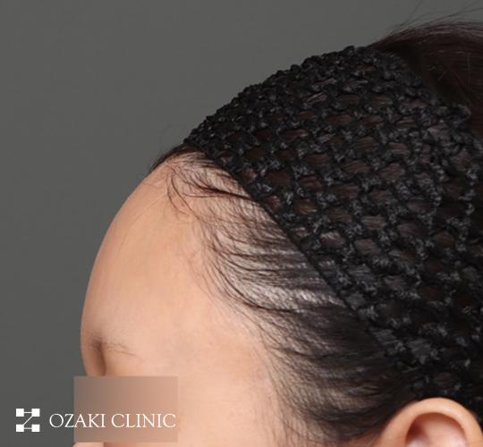 20代女性の額縮小 After 症例写真