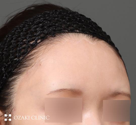 20代女性の生え際前進術 After 症例写真