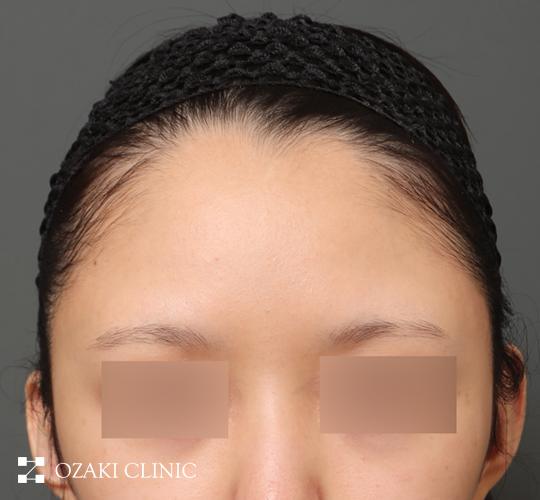 20代女性の額縮小 Before 症例写真