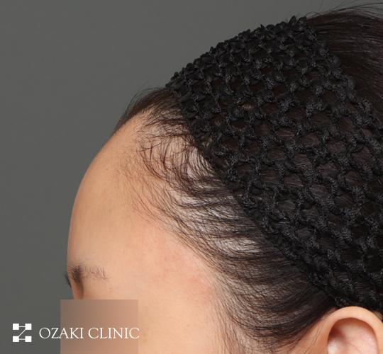 20代女性の額縮小 Before 症例写真