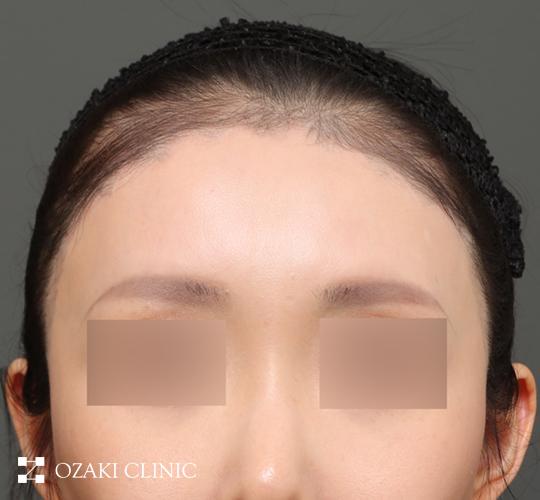 30代女性の額縮小 After 症例写真