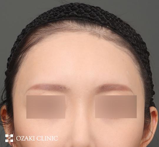 30代女性の額縮小 Before 症例写真