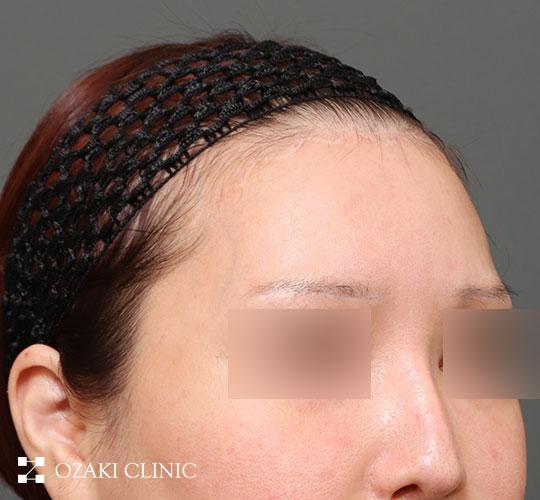 30代女性の生え際前進術 After 症例写真