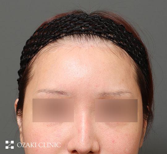 30代女性の額縮小 After 症例写真