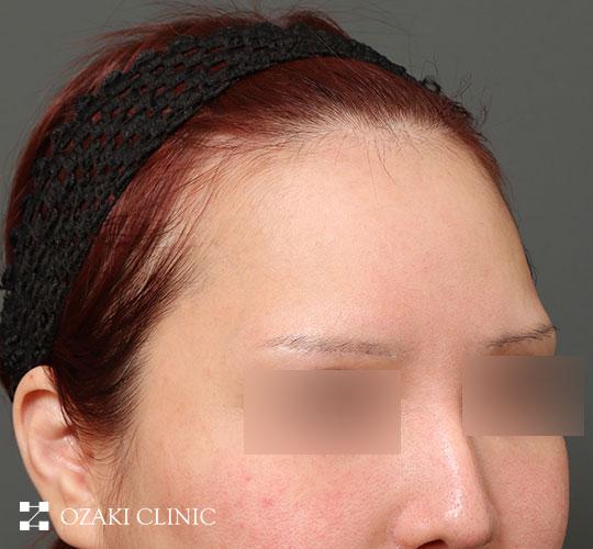 30代女性の生え際前進術 Before 症例写真