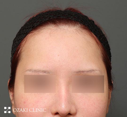 30代女性の額縮小 Before 症例写真