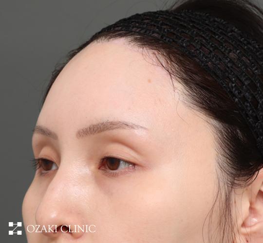 30代女性の額縮小 After 症例写真