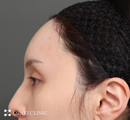 30代女性の額縮小 After 症例写真