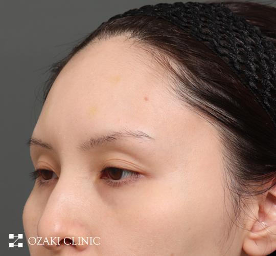 30代女性の額縮小 Before 症例写真