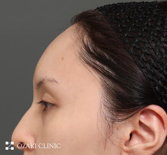 30代女性の額縮小 Before 症例写真