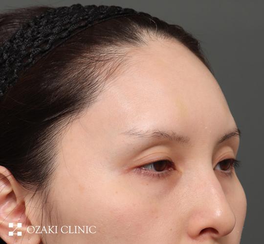 30代女性の額縮小 Before 症例写真